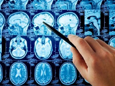 Brain tumour treatment information: neurosurgery