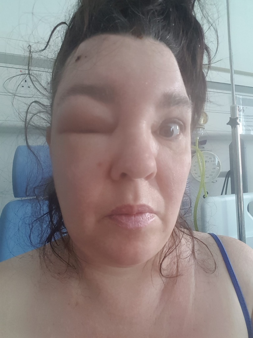 Jackie after surgery